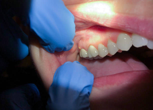 Best Emergency Dental Care for Broken or Chipped Teeth in Farrell, PA